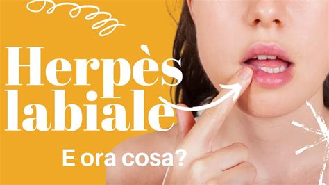 HERPES LABIALE: CHE COS’E’ E QUANDO PREOCCUPARSI.